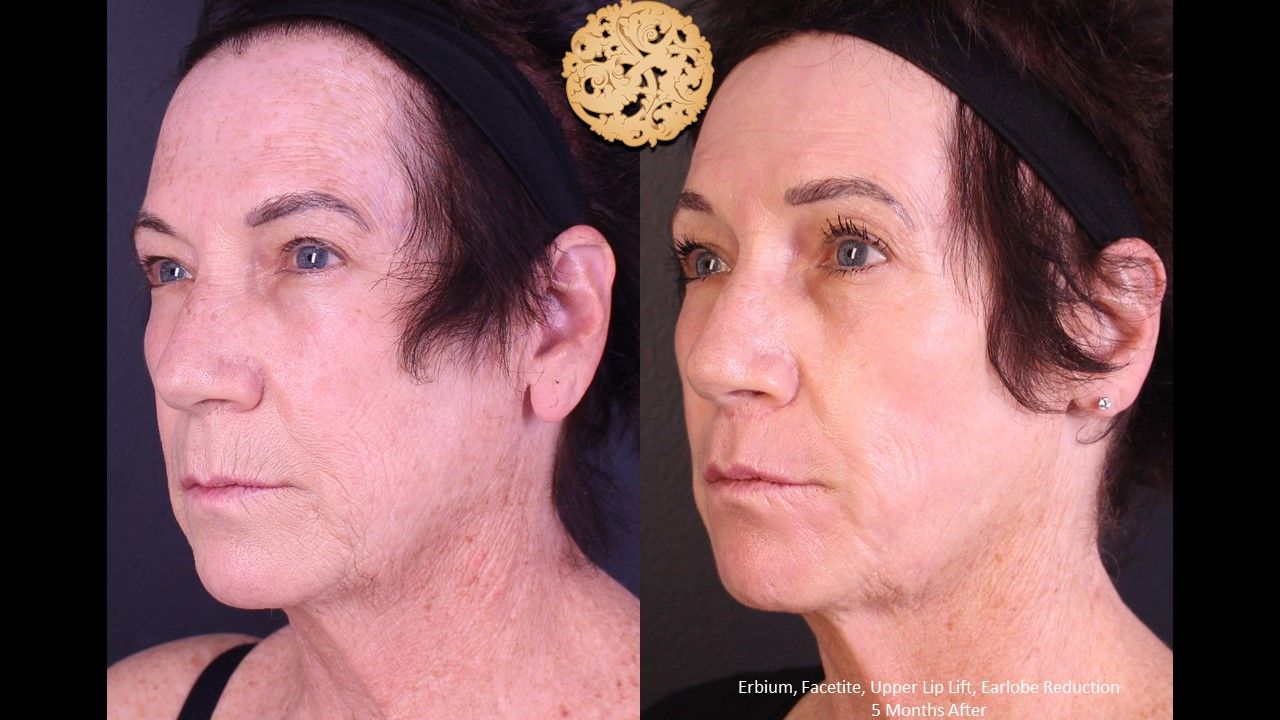 Erbium Laser Before & After