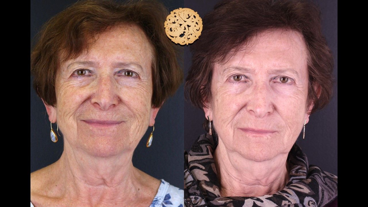 Erbium Laser Before & After