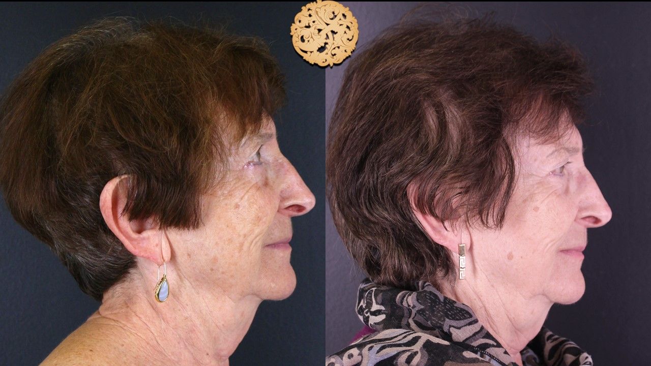 Erbium Laser Before & After