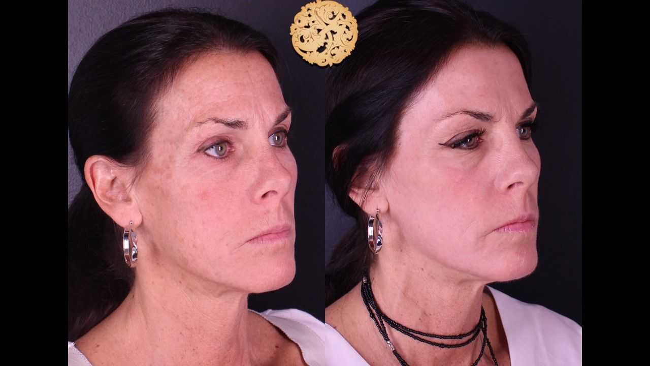 Erbium Laser Before & After