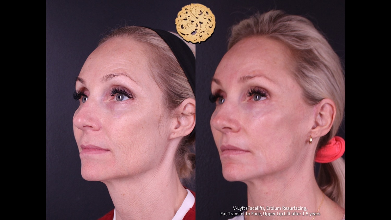Before and after facial rejuvenation treatment comparison.