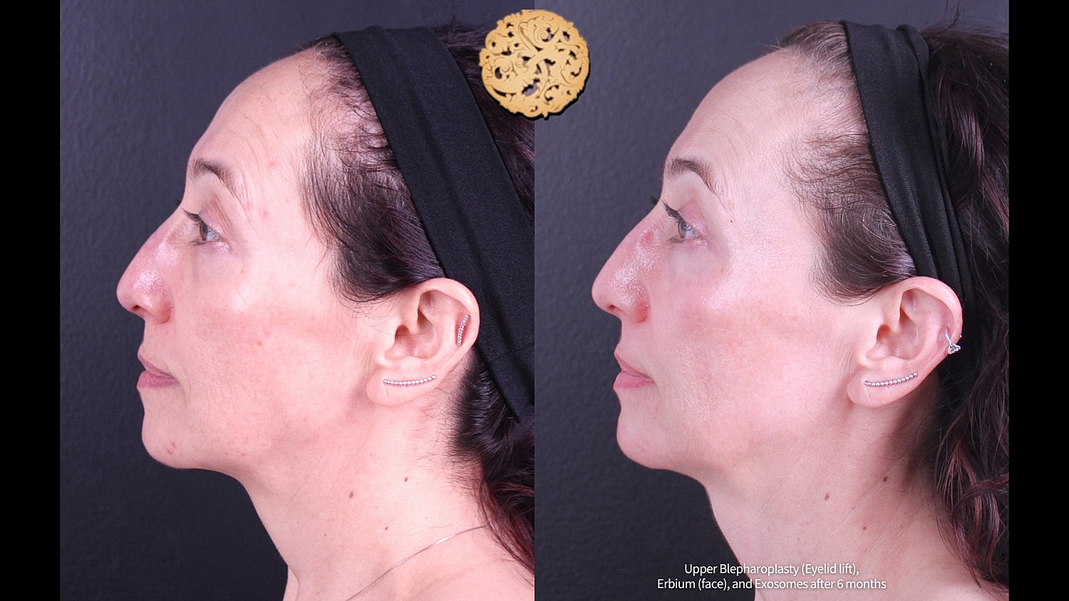 Erbium Laser Before & After