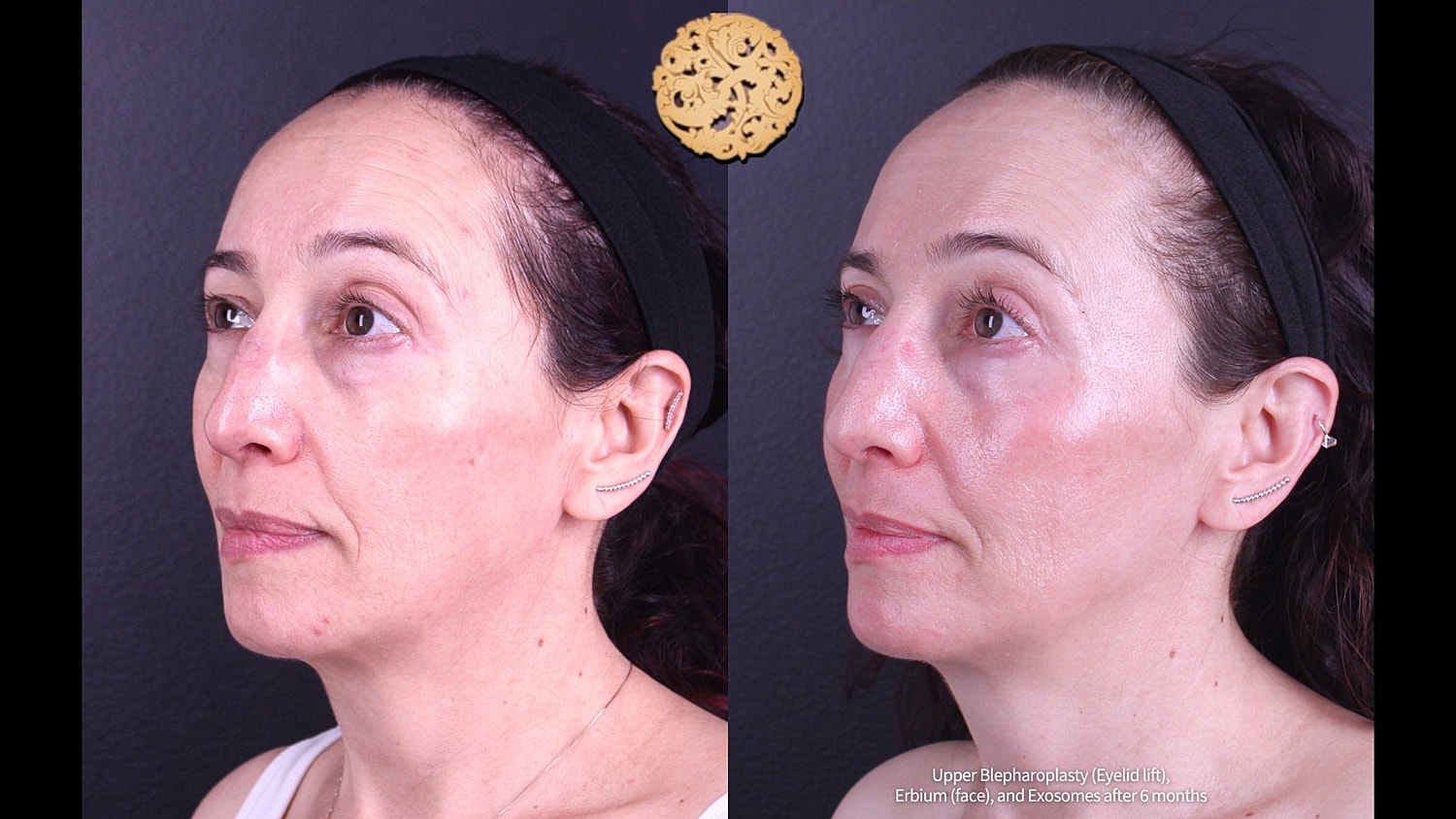 Erbium Laser Before & After