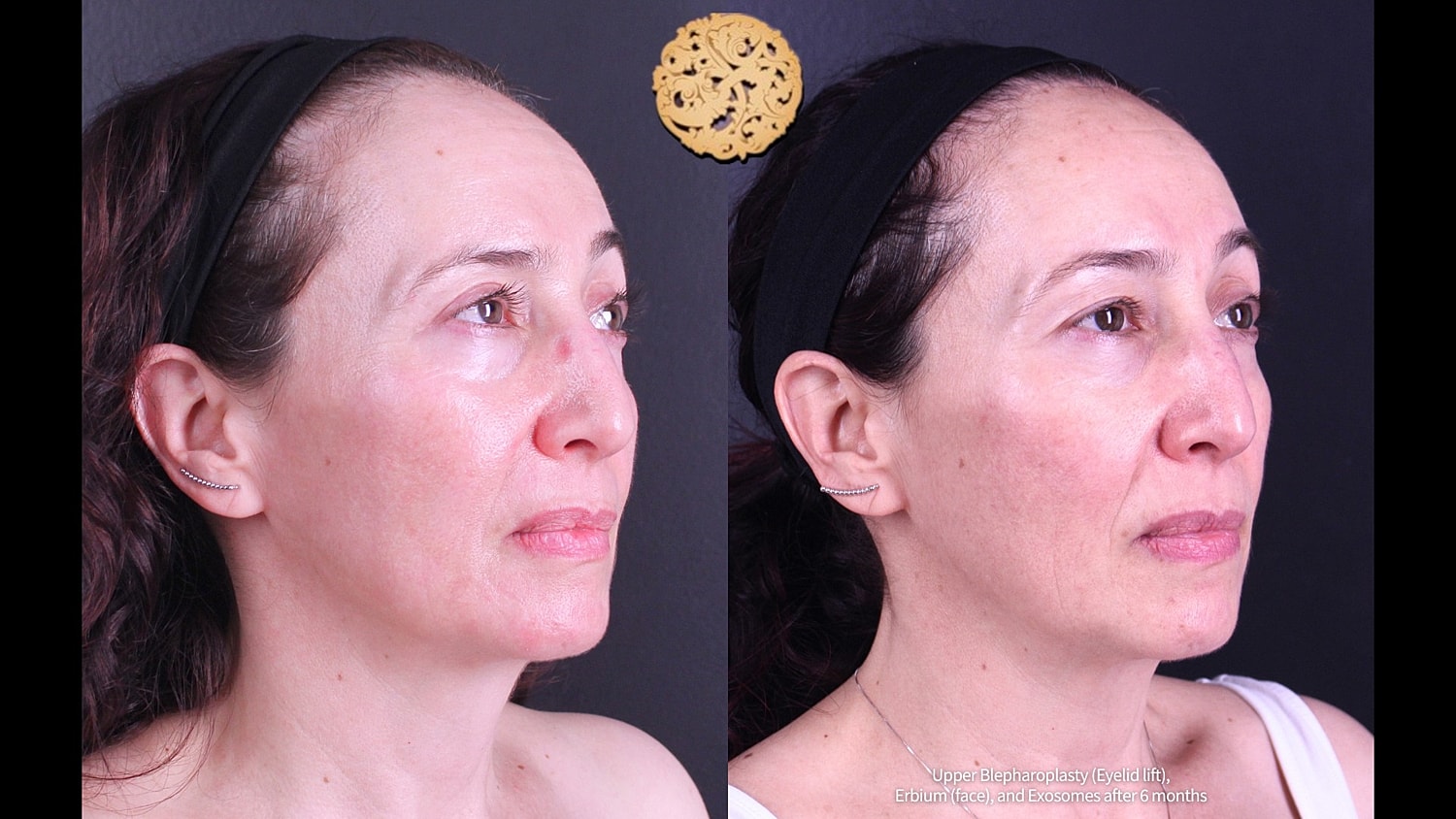 Erbium Laser Before & After