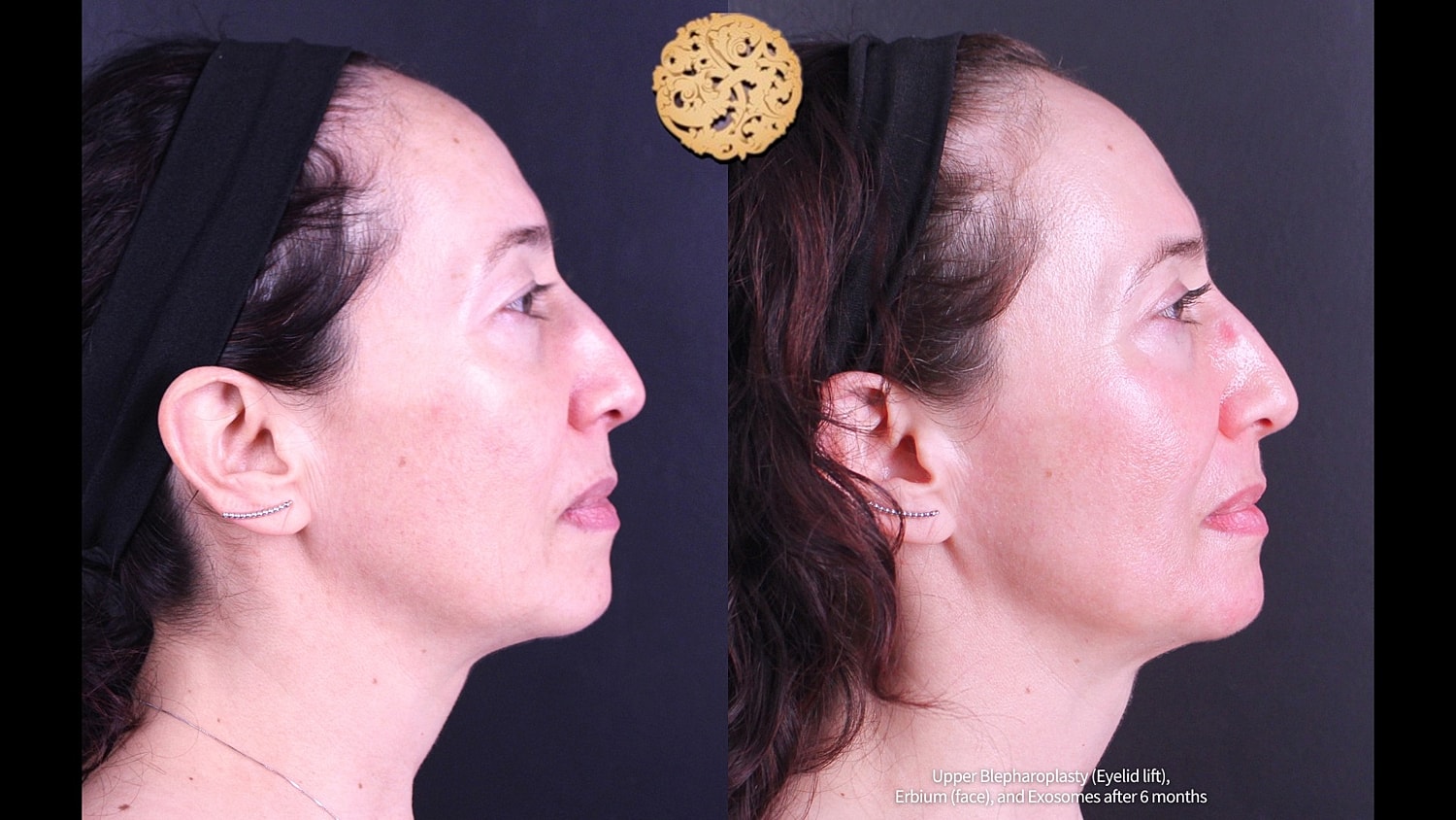 Erbium Laser Before & After