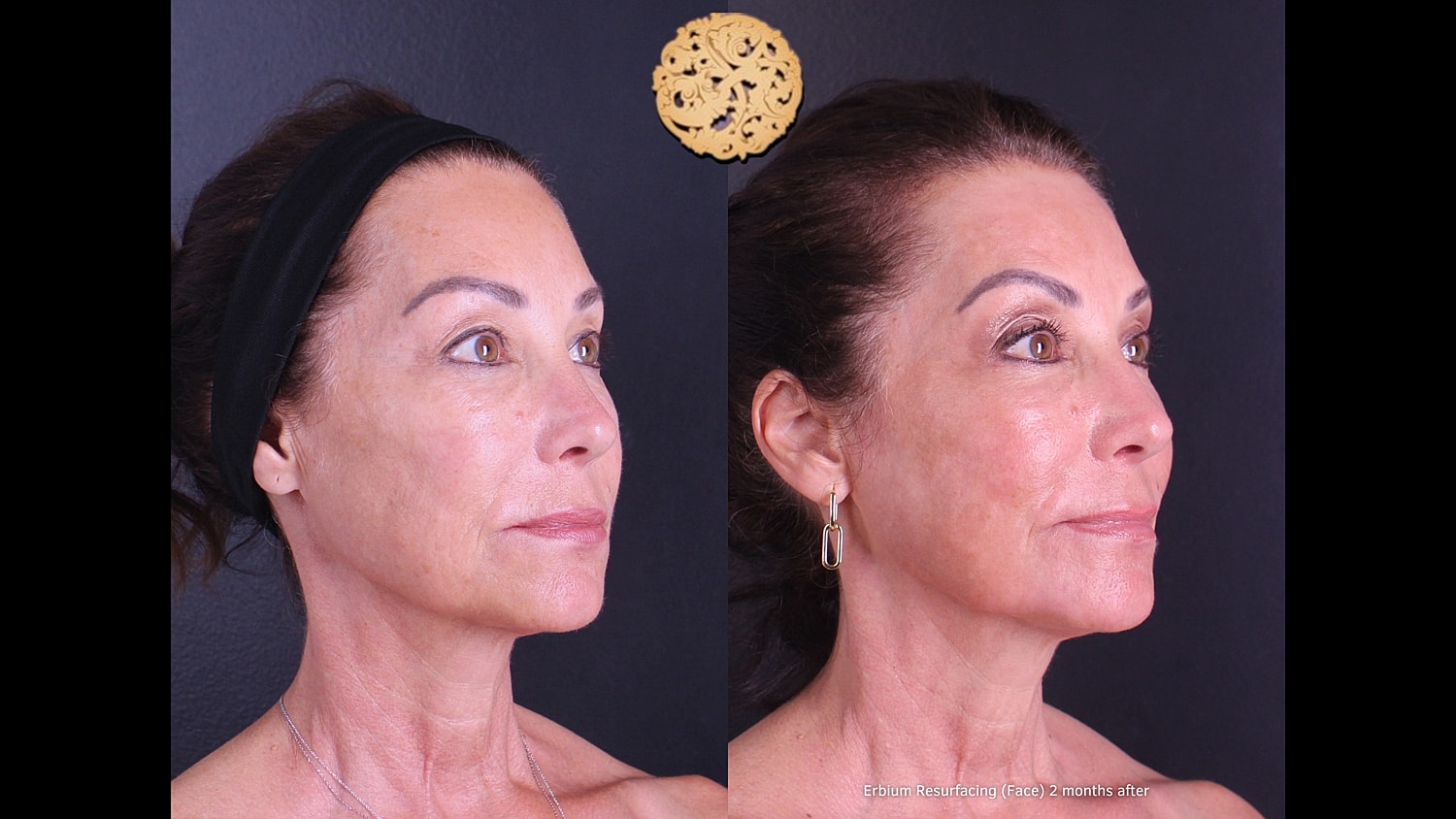 Erbium Laser Before & After