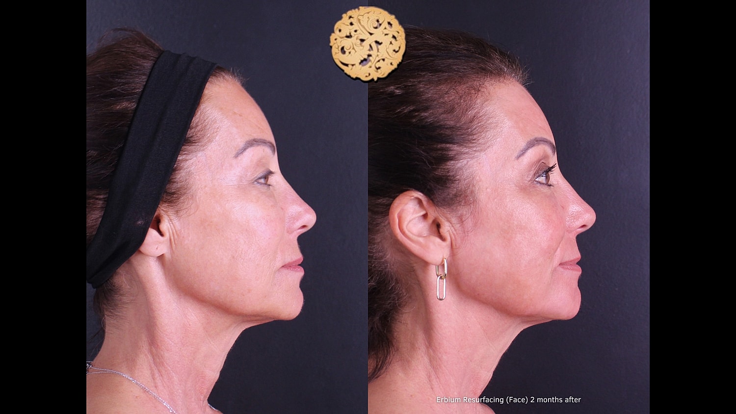 Erbium Laser Before & After