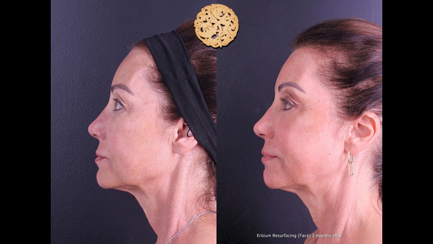 Erbium Laser Before & After
