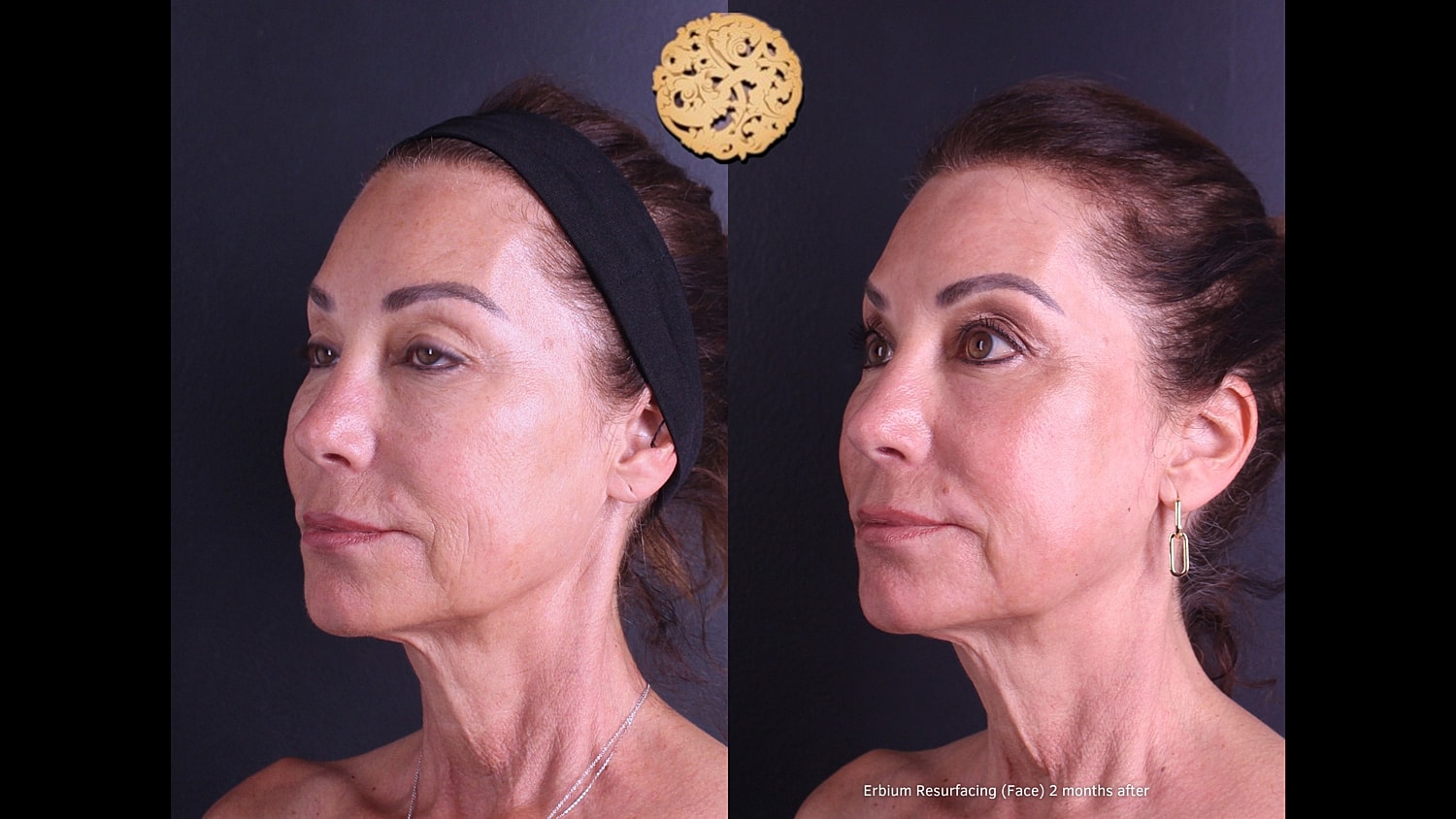 Erbium Laser Before & After