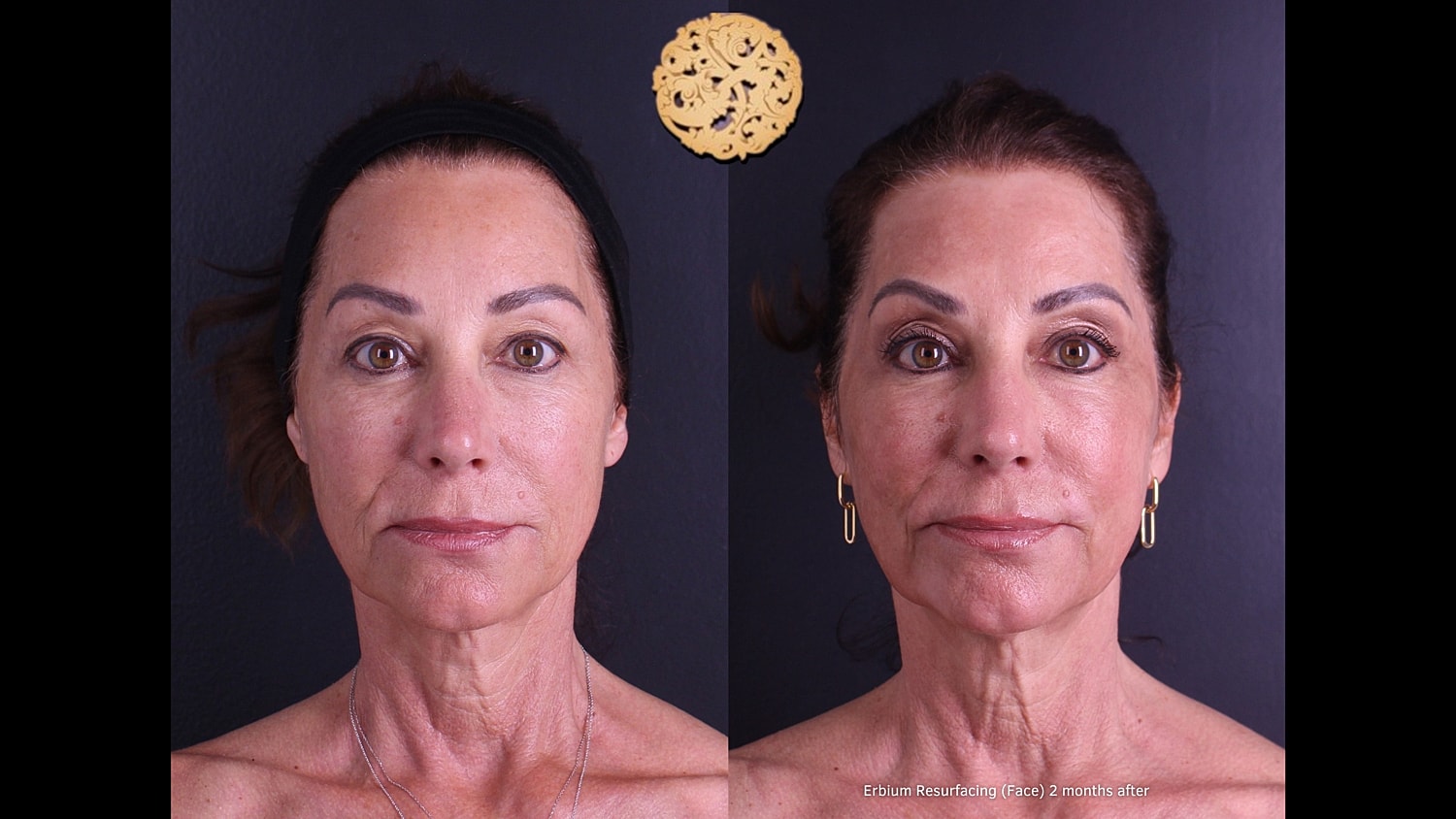 Erbium Laser Before & After