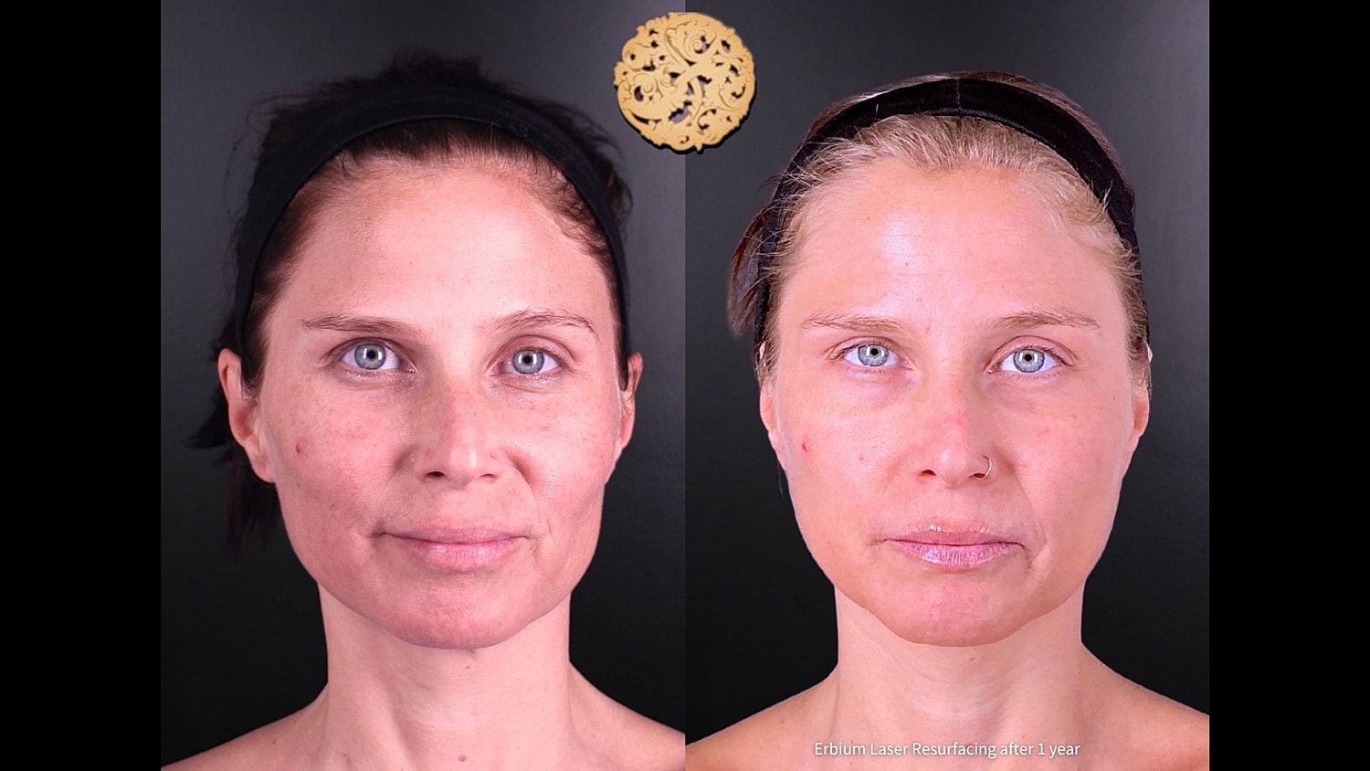Erbium Laser Before & After