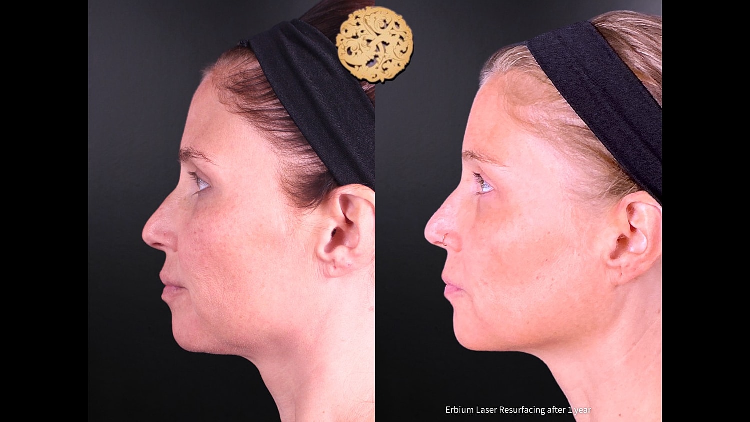 Erbium Laser Before & After