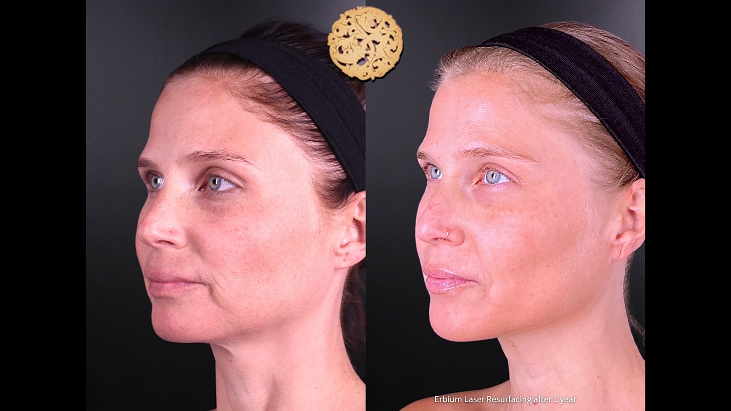 Erbium Laser Before & After