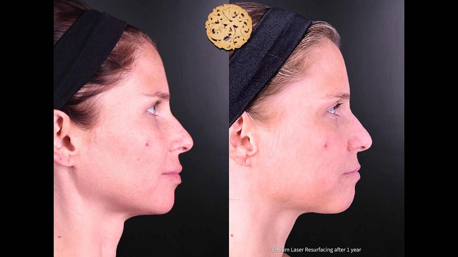 Erbium Laser Before & After