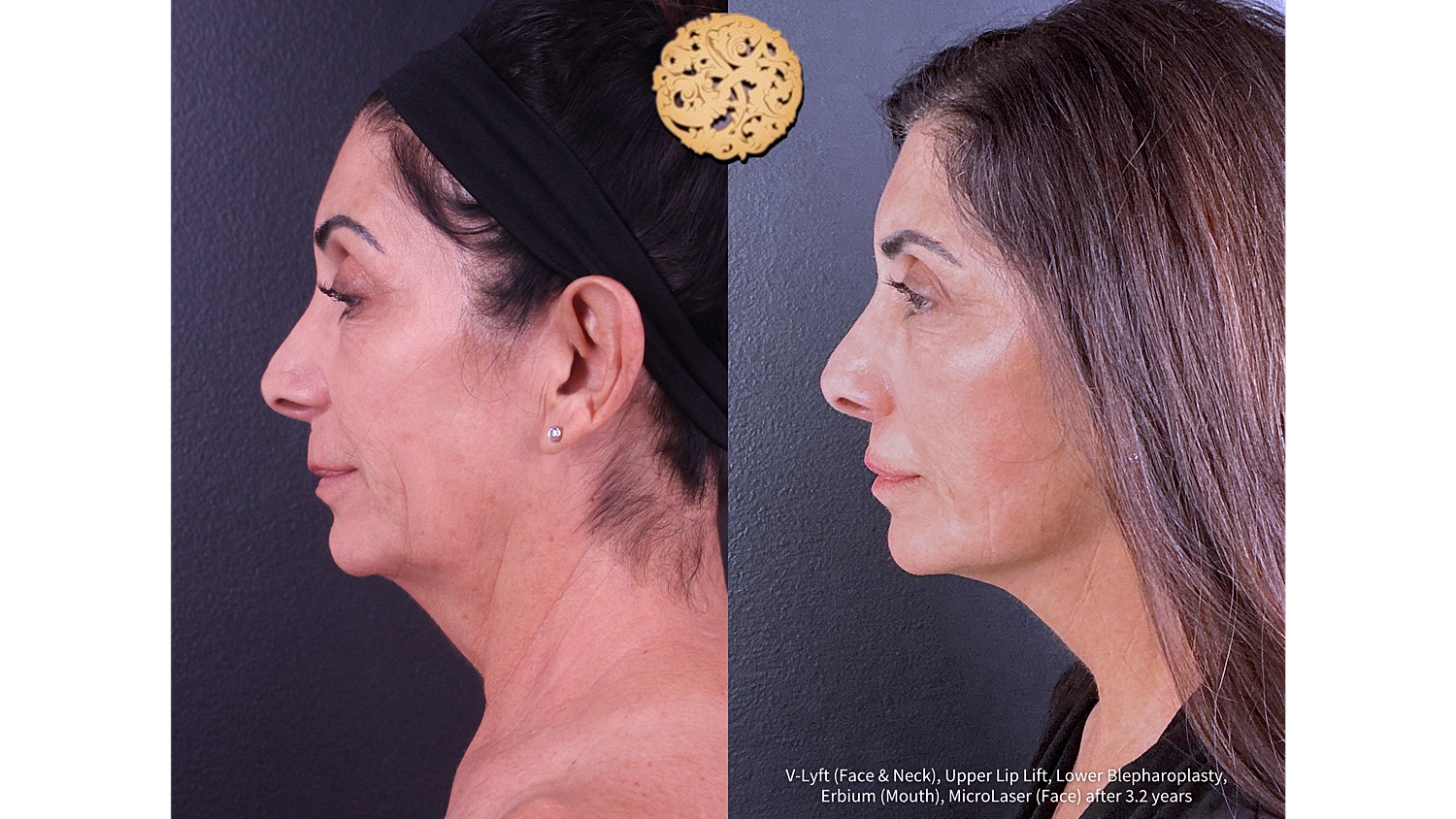 Erbium (Mouth) Before and After