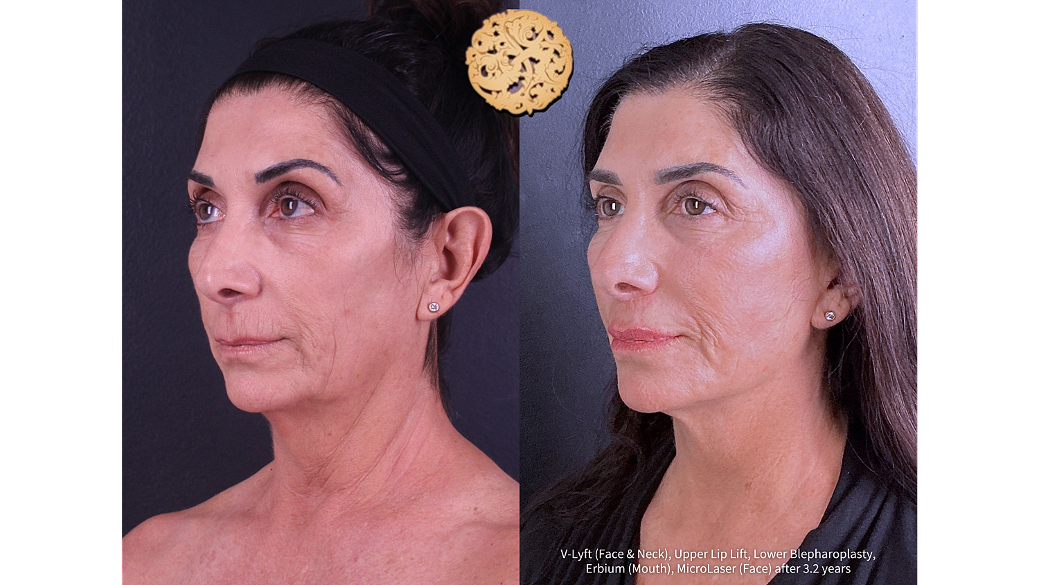 Erbium (Mouth) Before and After