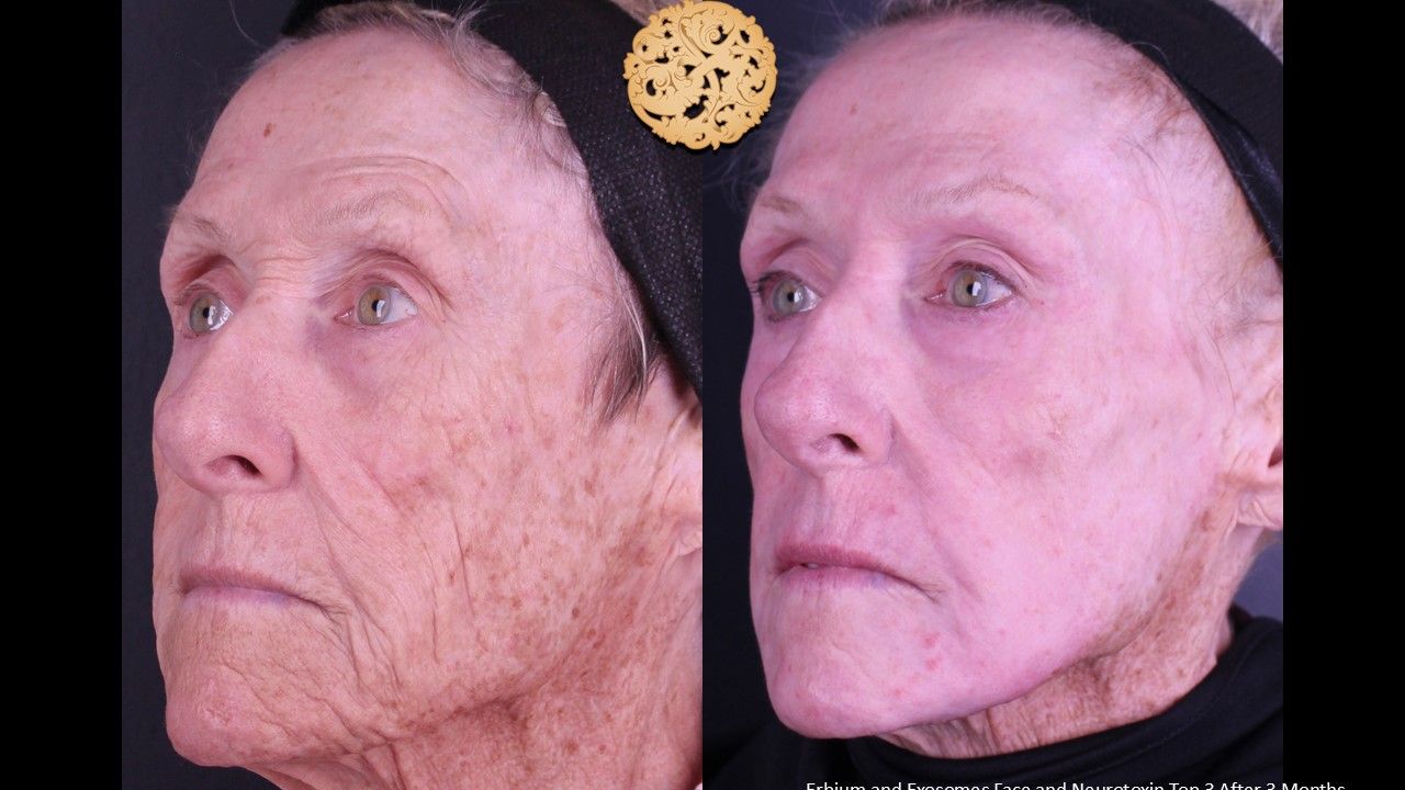 Erbium Laser Before & After