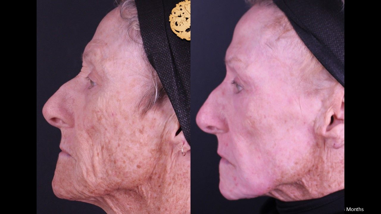 Erbium Laser Before & After