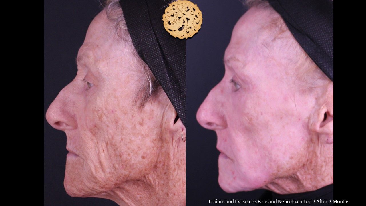 Erbium Laser Before & After