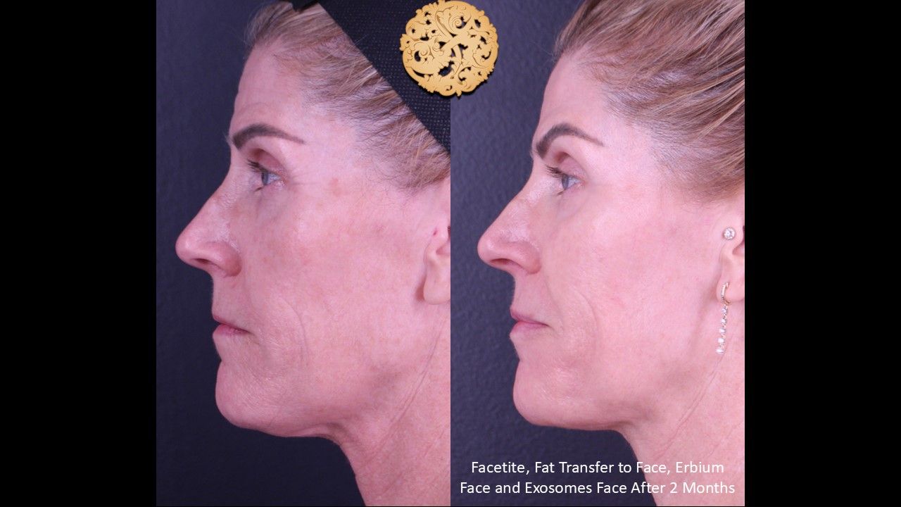 Erbium Laser Before & After