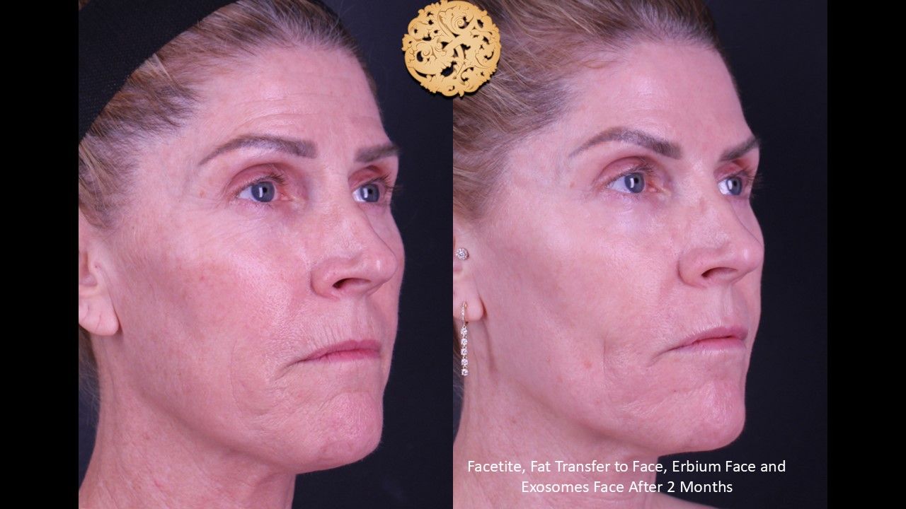 Erbium Laser Before & After