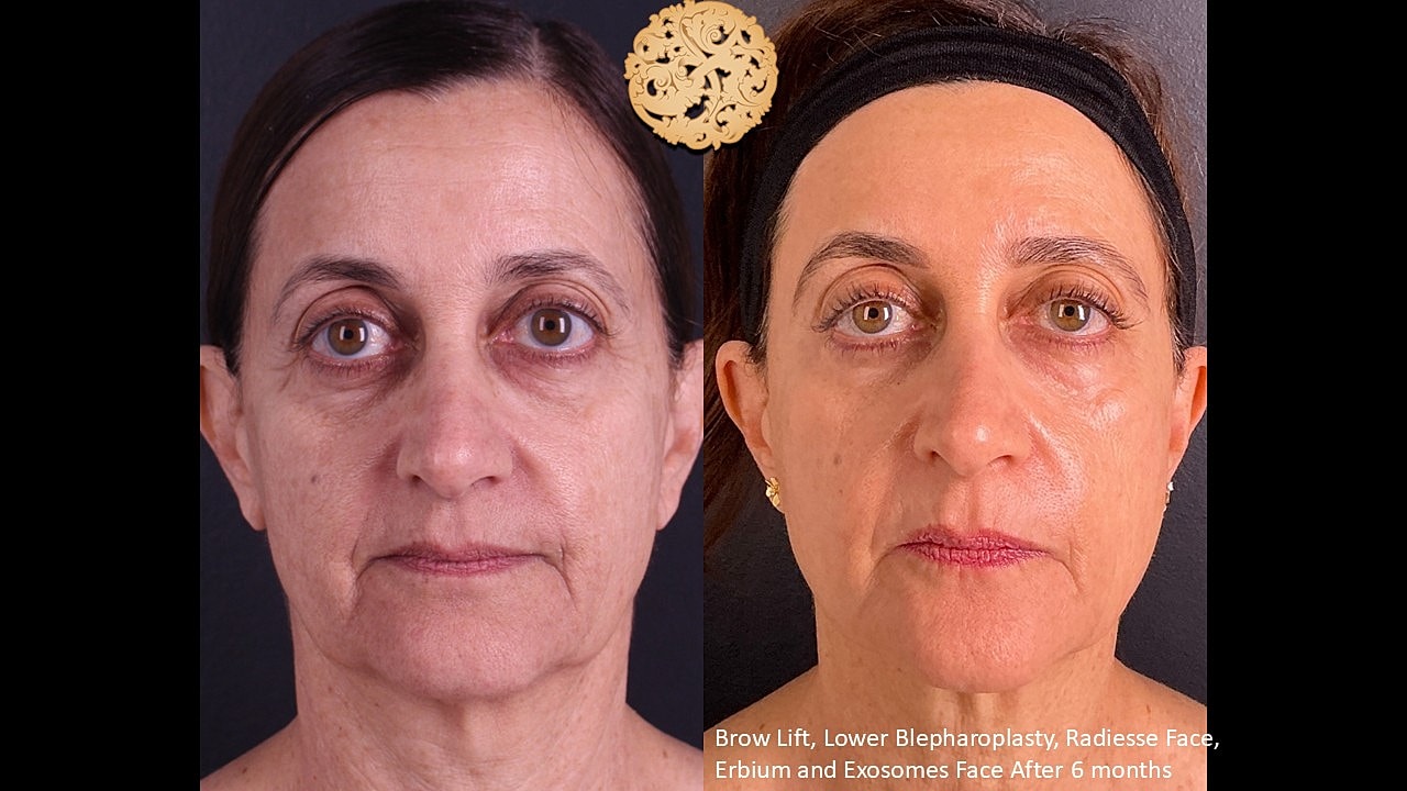 Erbium Laser Before & After
