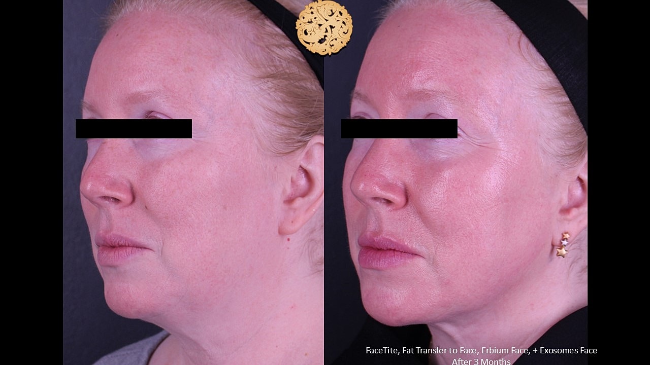 Before and after facial cosmetic procedures.