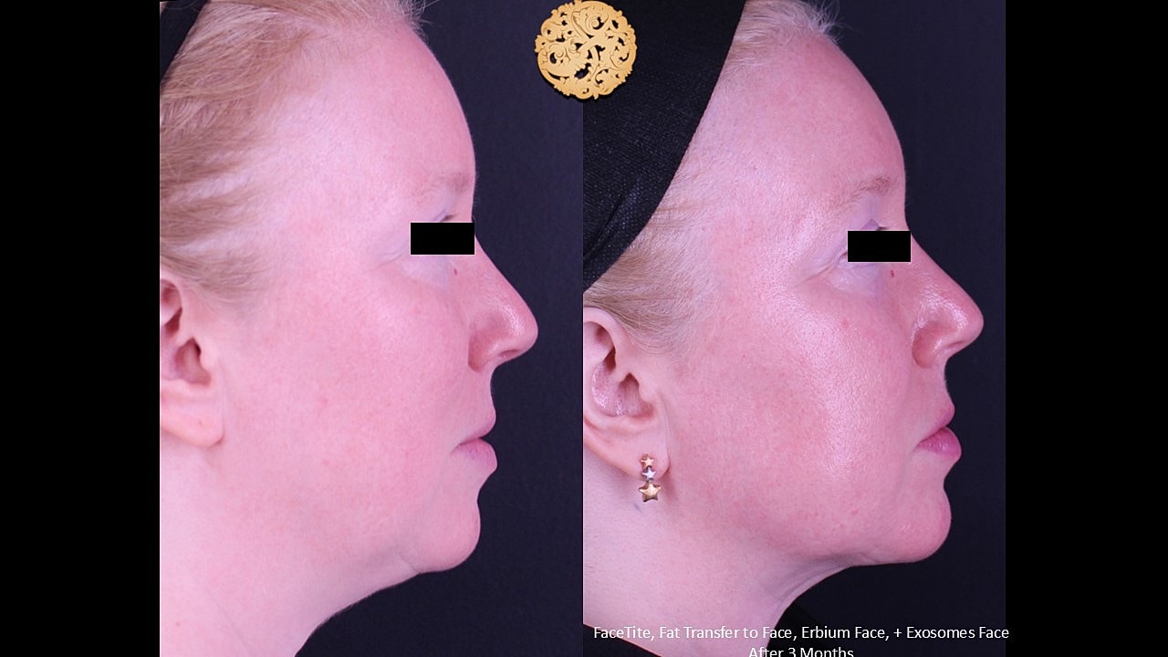 Before and after facial treatment comparison.