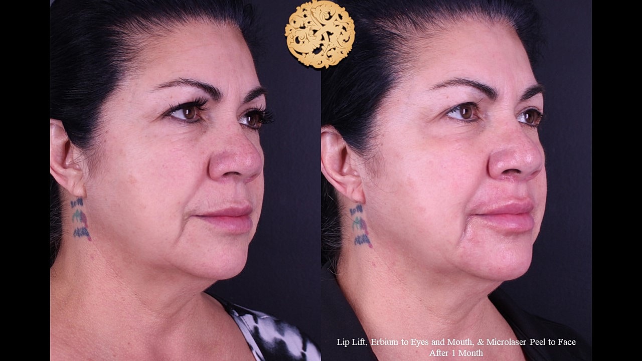 Erbium Laser Before & After