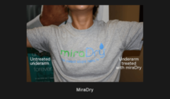 miraDry Before & After