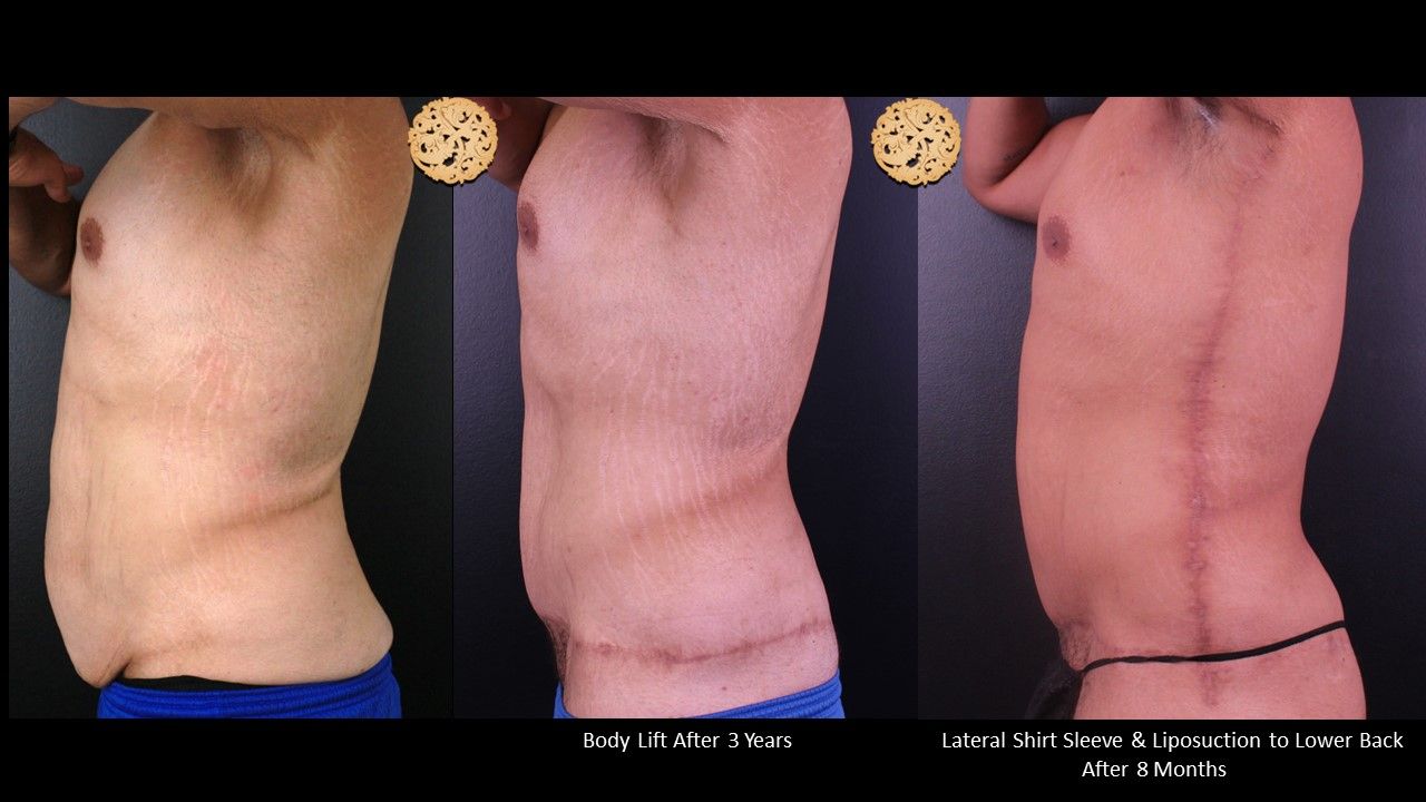 Body Lift Before & After