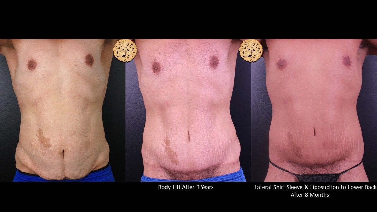 Body Lift Before & After