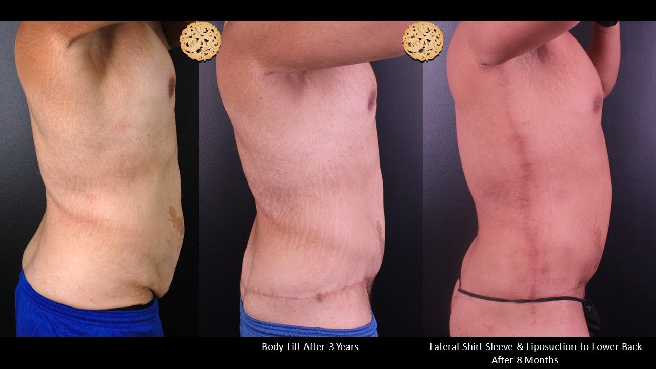 Body Lift Before & After