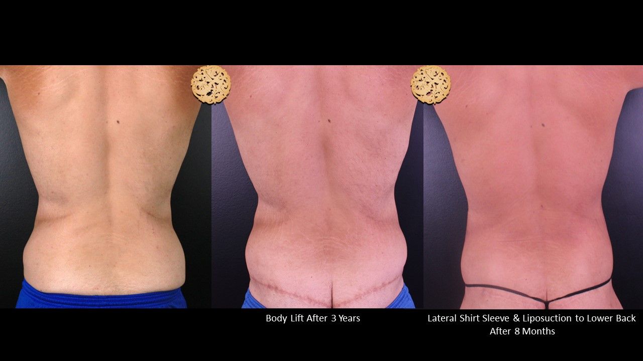 Body Lift Before & After