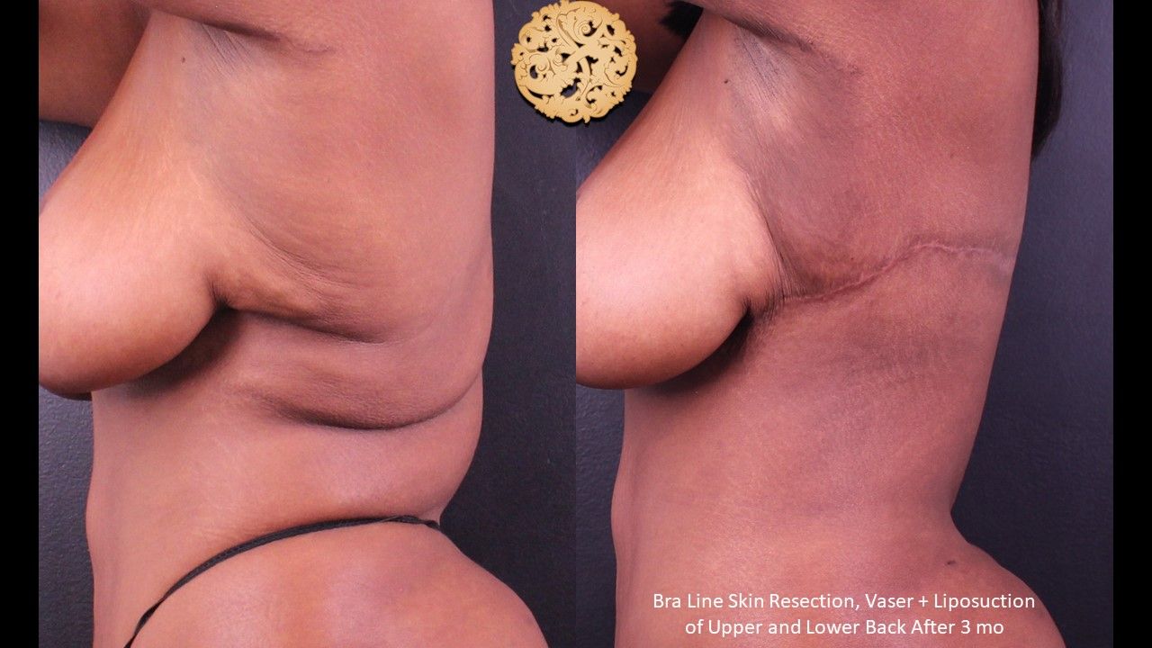 Body Lift Before & After