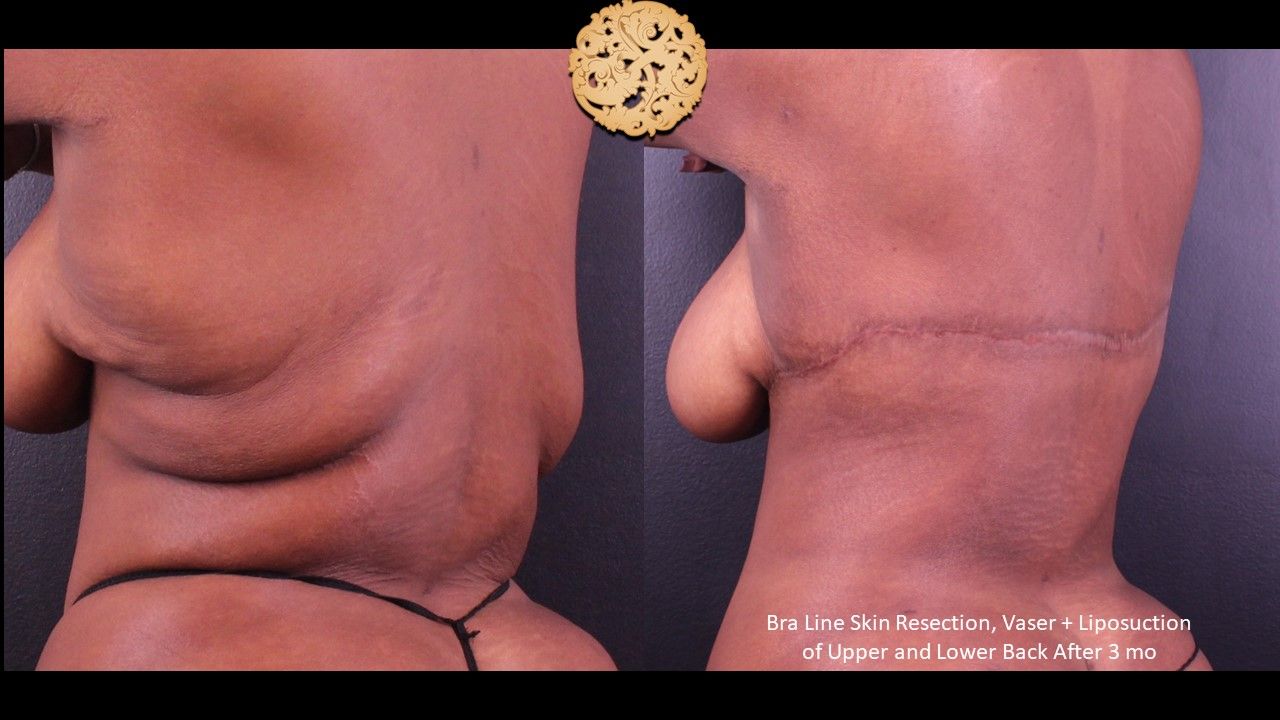 Body Lift Before & After