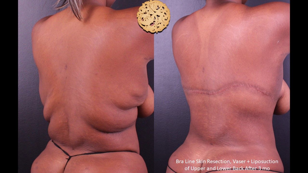 Body Lift Before & After