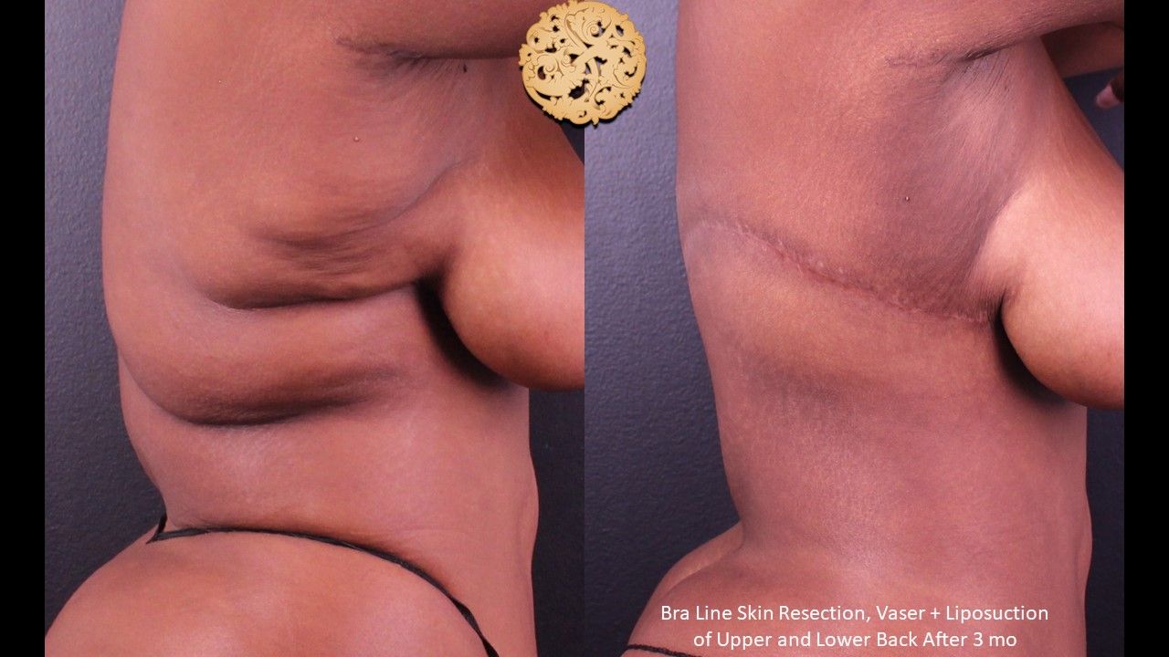 Body Lift Before & After