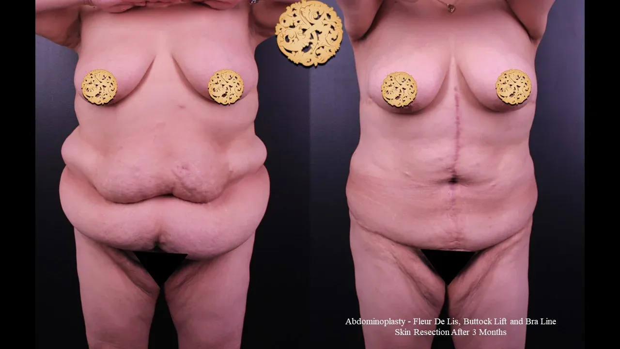 Body Lift Before & After