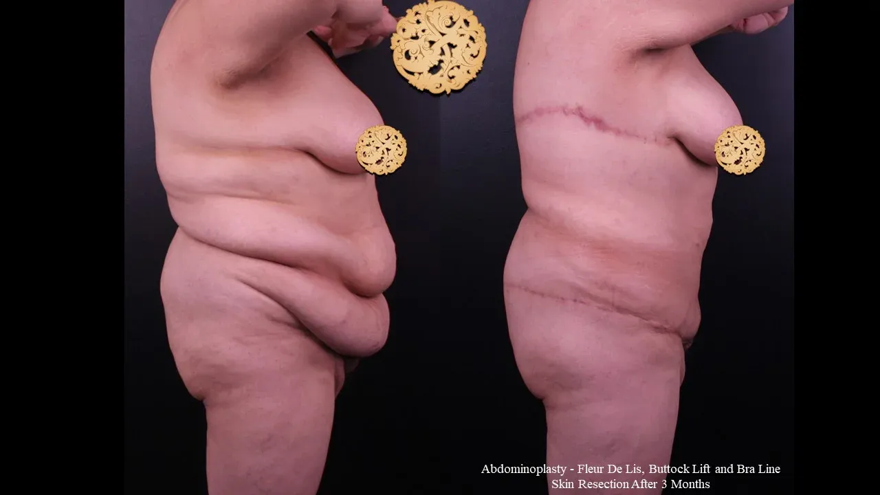 Body Lift Before & After