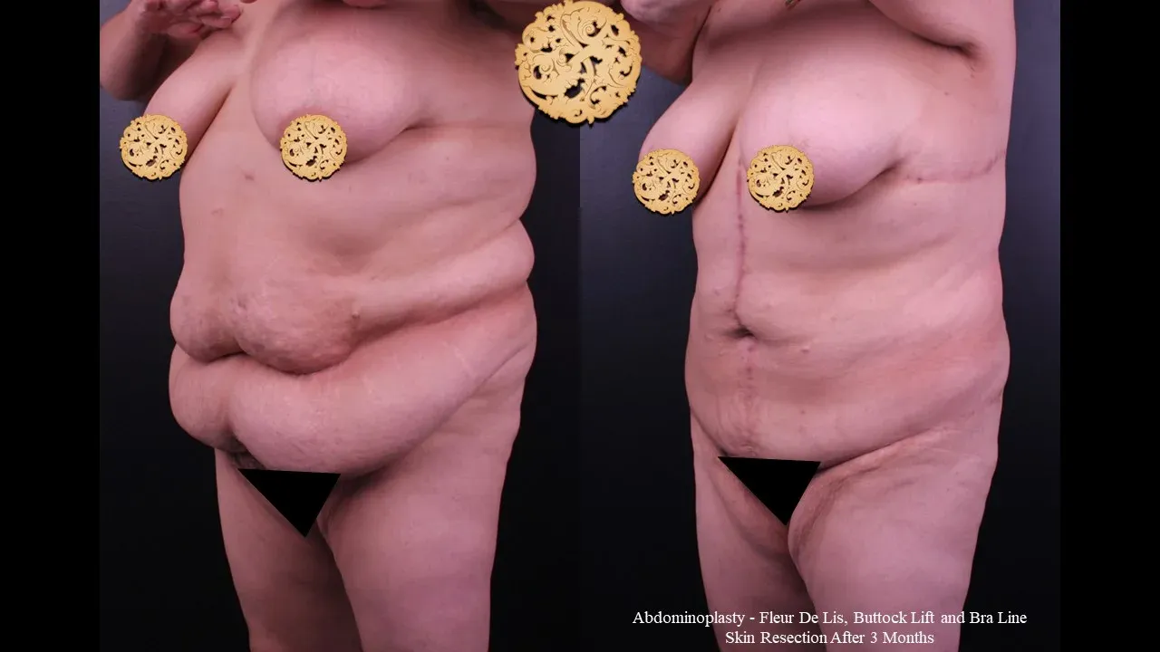 Body Lift Before & After