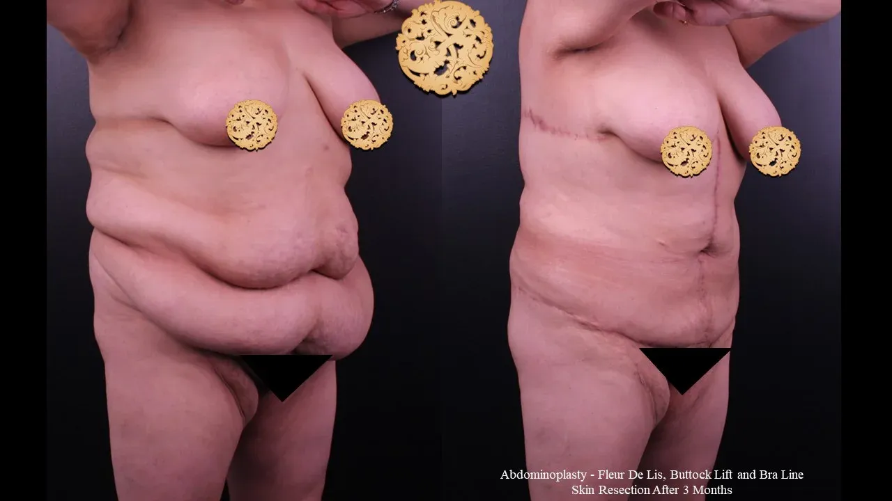 Body Lift Before & After