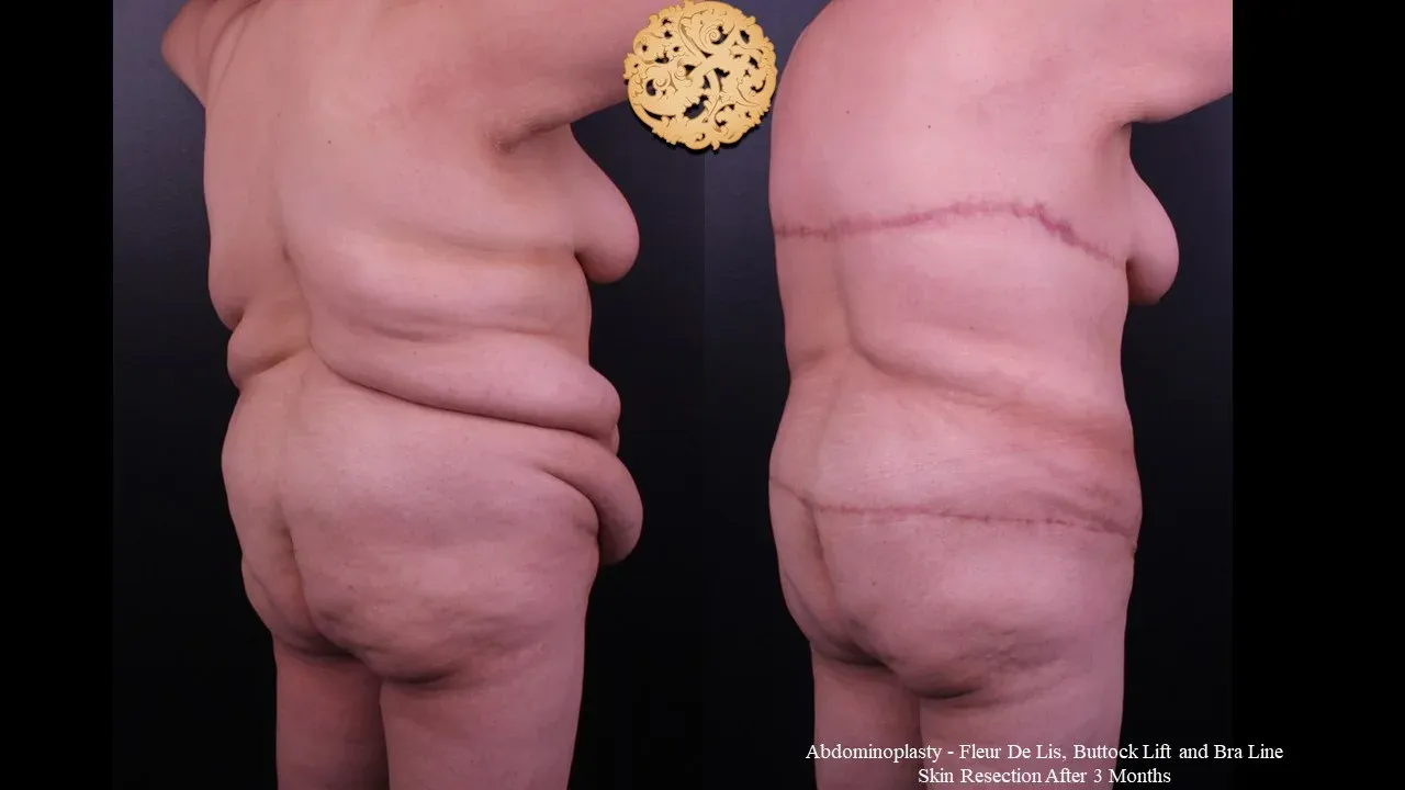 Body Lift Before & After