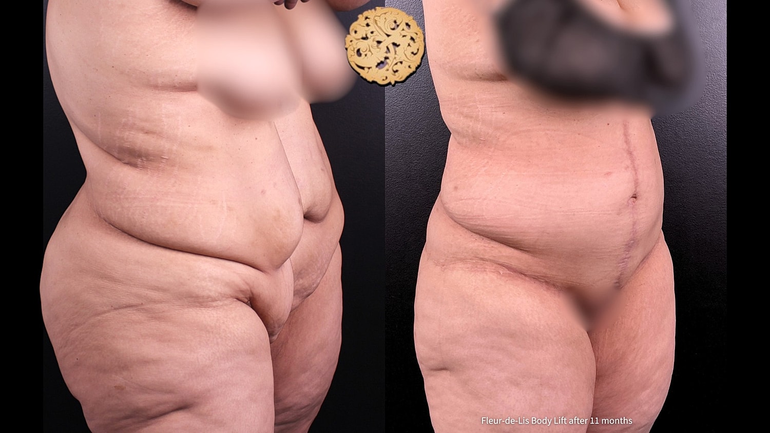 Body Lift Before & After
