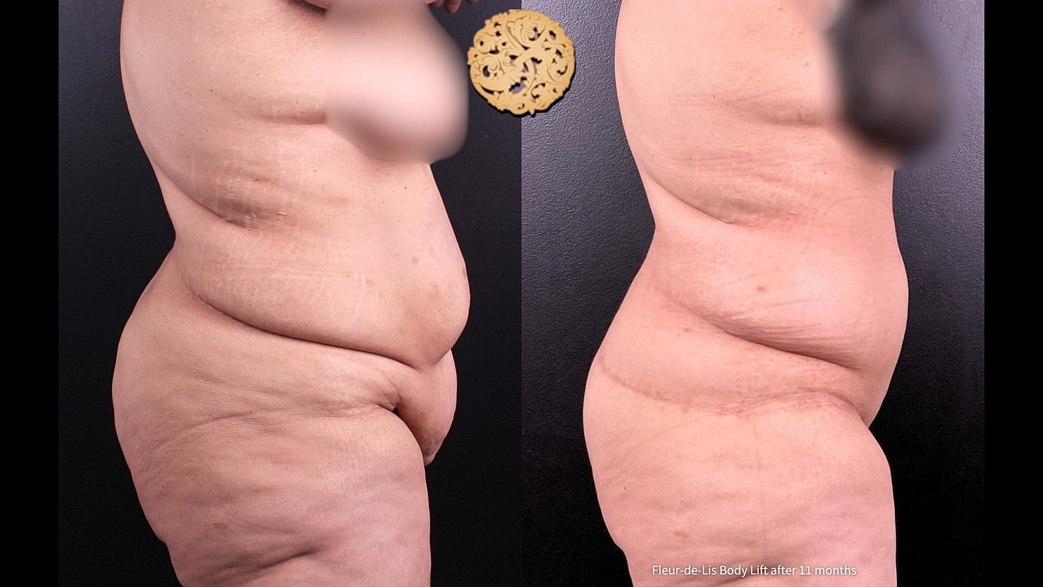 Body Lift Before & After