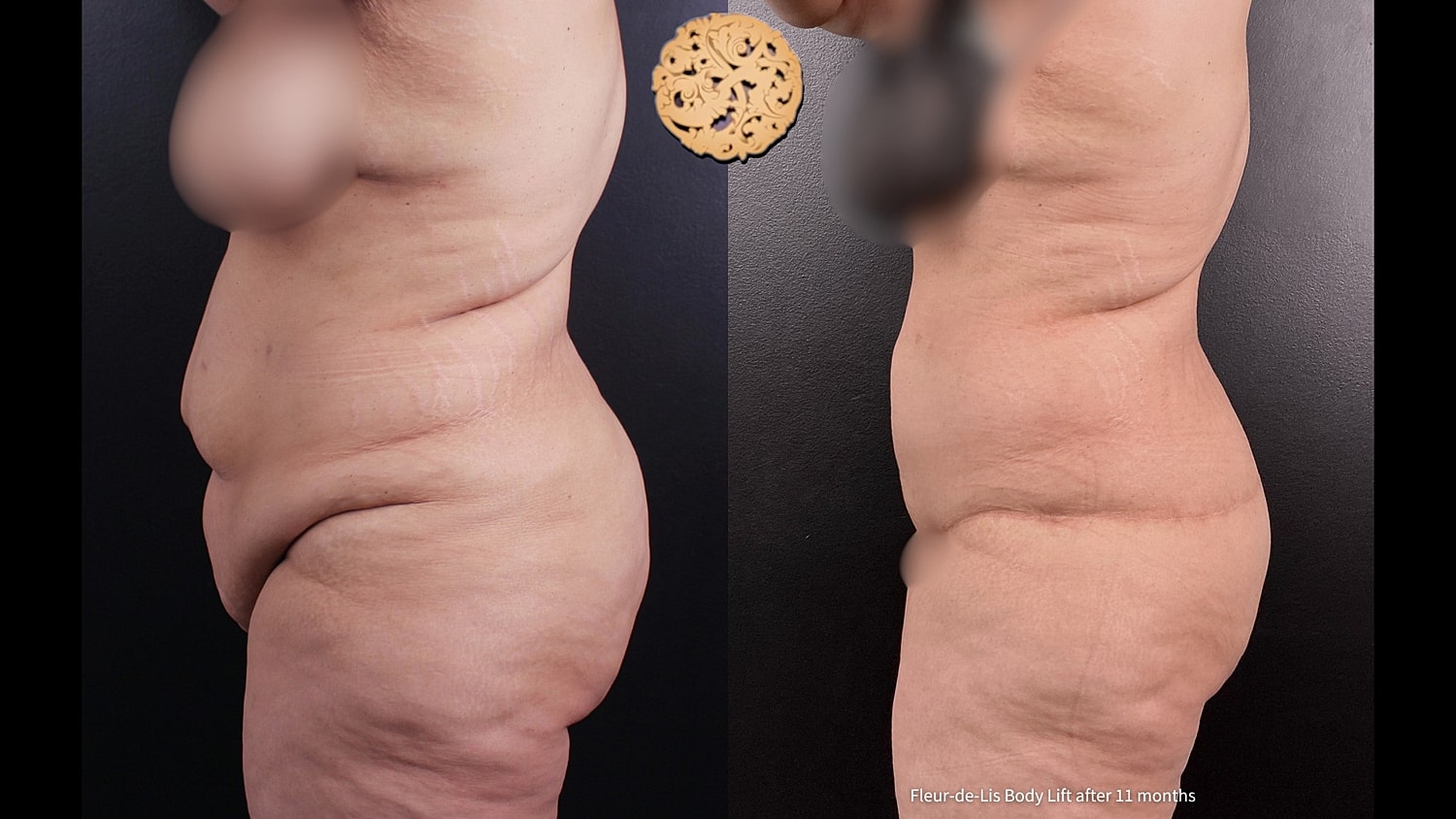 Body Lift Before & After