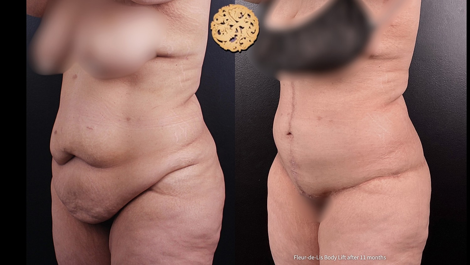 Body Lift Before & After