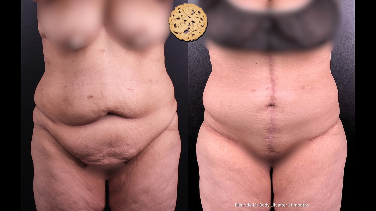Body Lift Before & After