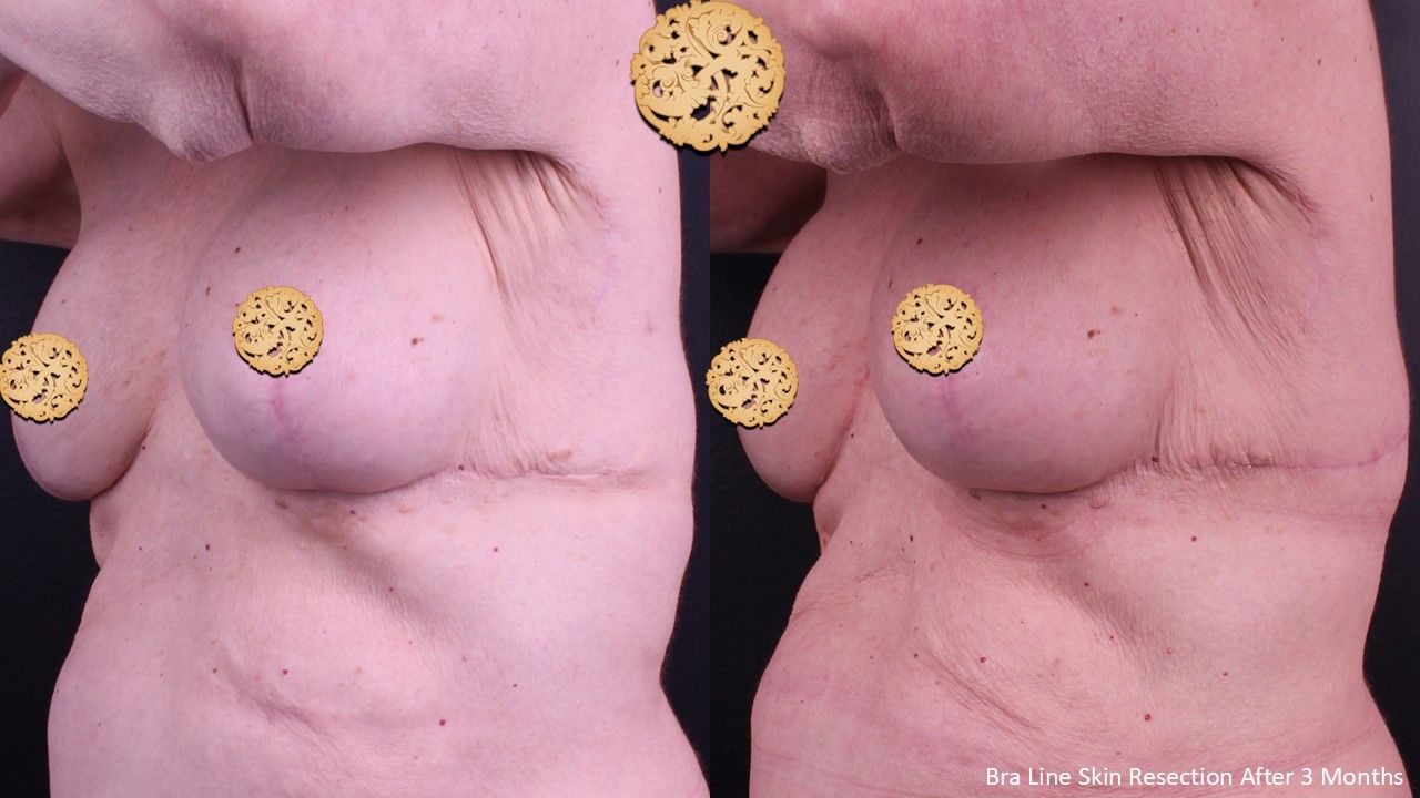 Body Lift Before & After