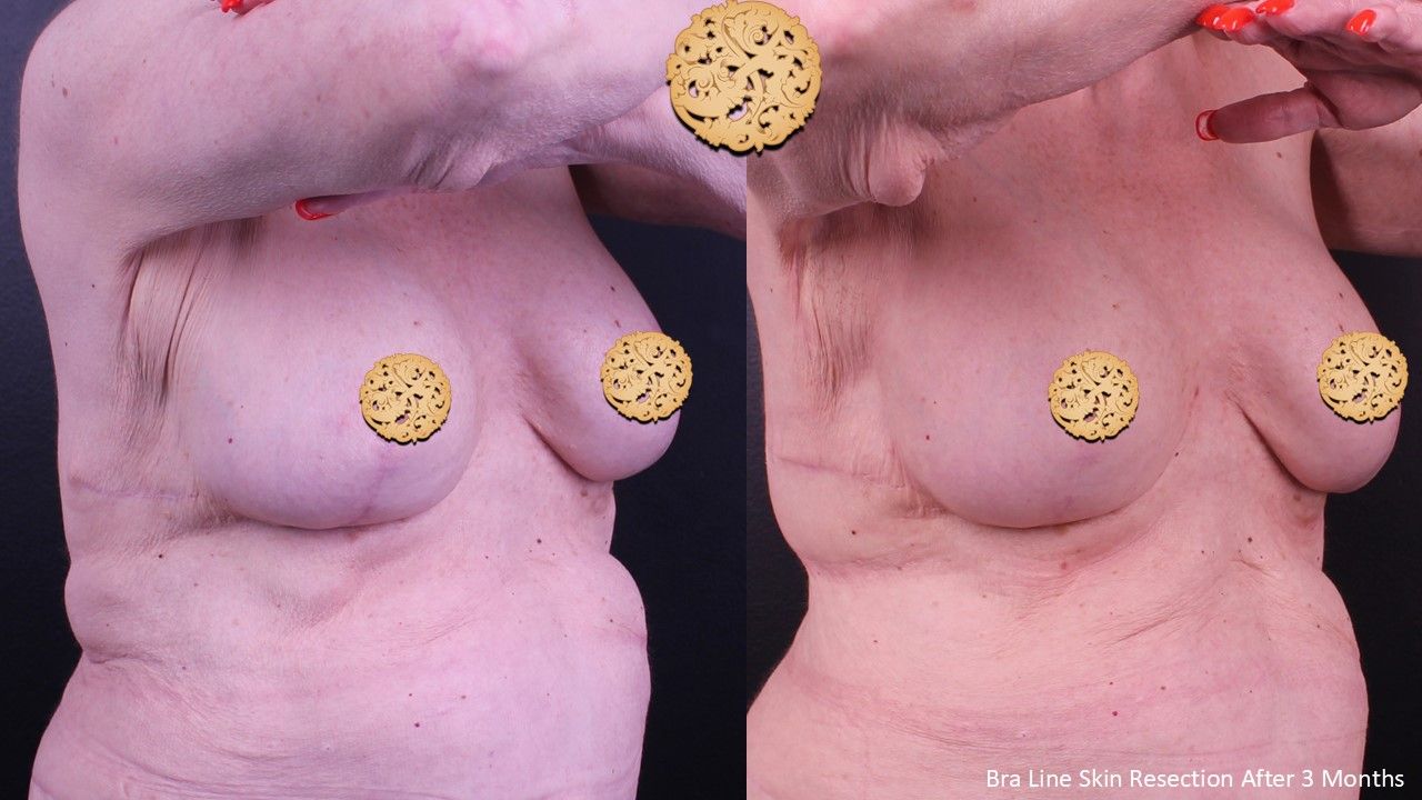 Body Lift Before & After